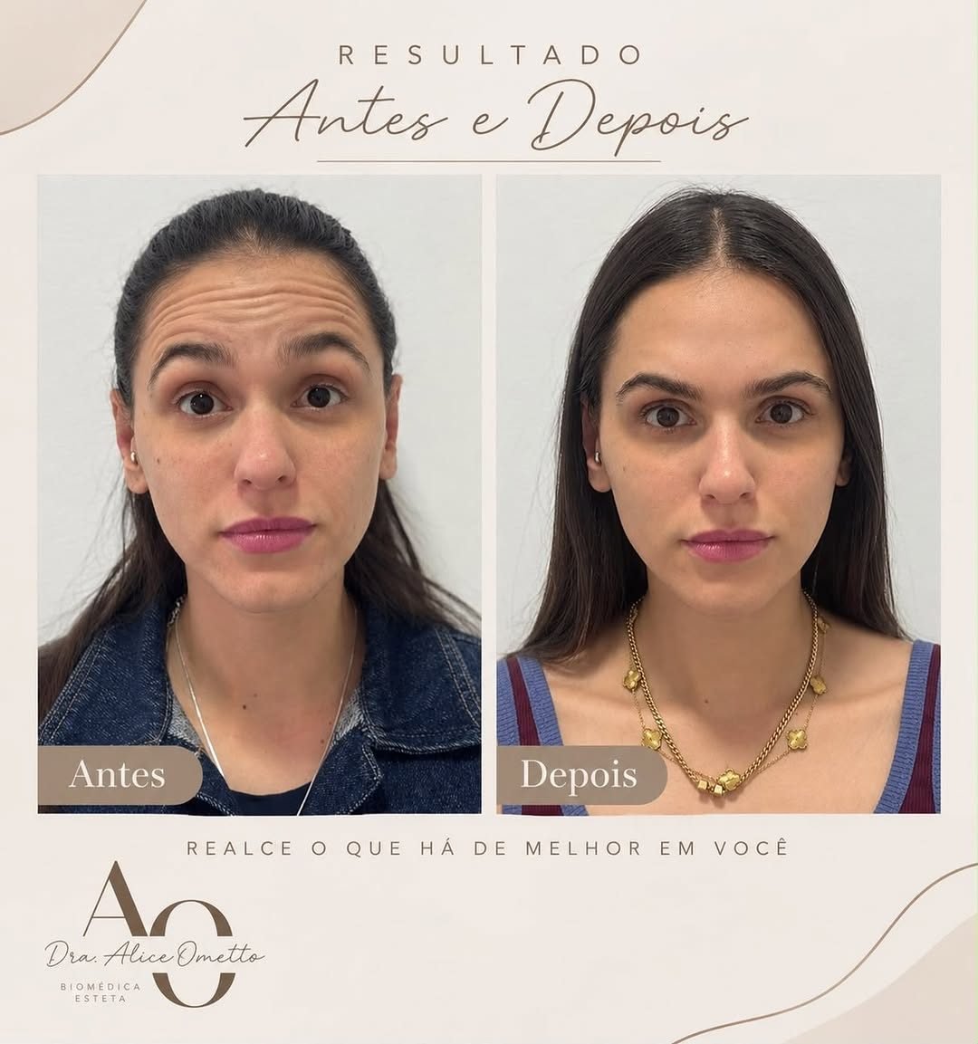 Antes e depois de toxina botulínica na testa