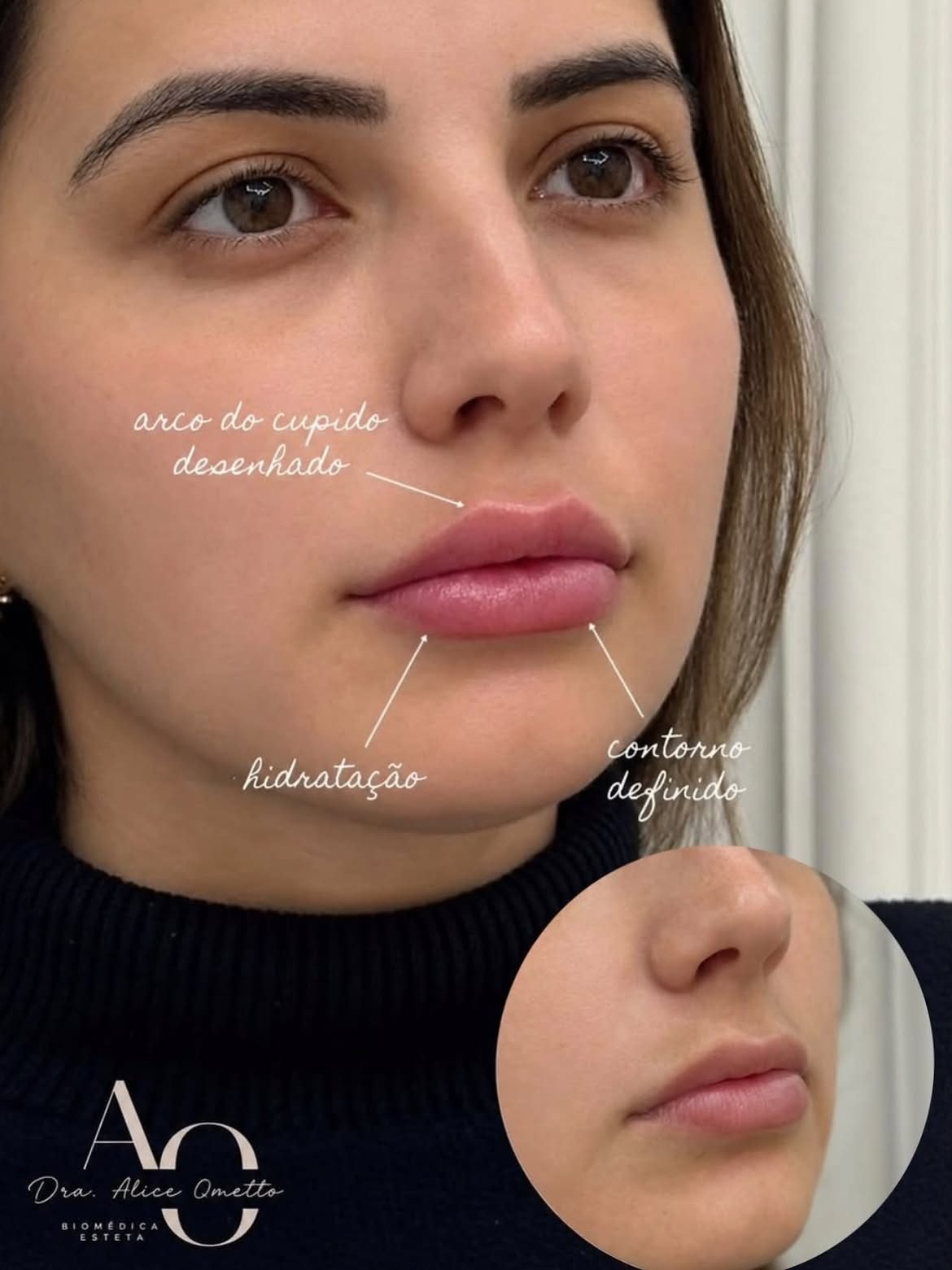 Resultado de preenchimento labial